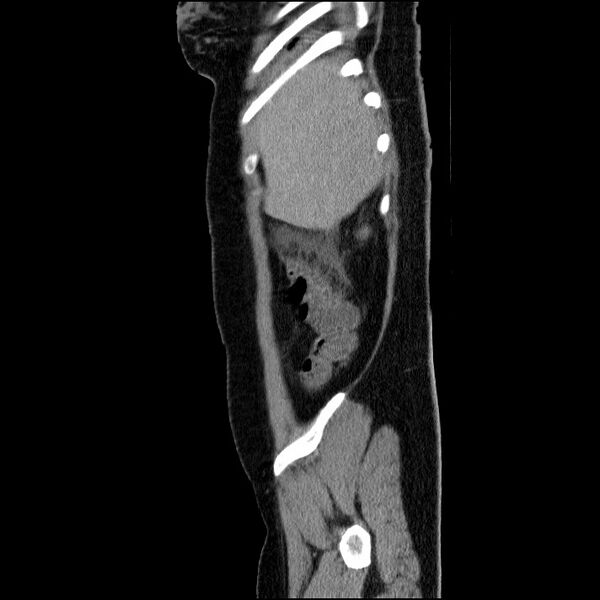 File:Acute pancreatitis (Radiopaedia 69236-79012 Sagittal C+ portal venous phase 82).jpg
