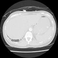 Acute pulmonary edema on CT (Radiopaedia 33582-34672 Axial lung window 51).jpg