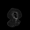 Acute pyelonephritis (Radiopaedia 25657-25837 Coronal renal parenchymal phase 9).jpg