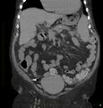 Acute renal failure post IV contrast injection- CT findings (Radiopaedia 47815-52557 Coronal non-contrast 15).jpg