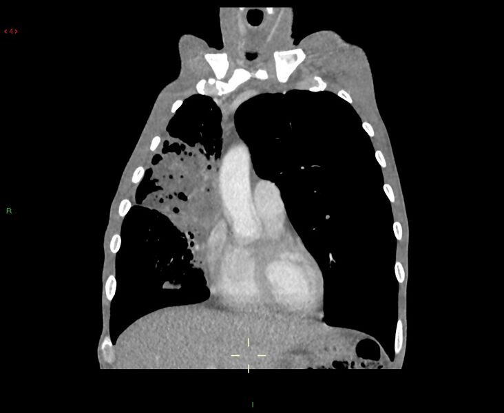 File:Acute right lung abscess (Radiopaedia 34806-36258 Coronal C+ arterial phase 41).jpg
