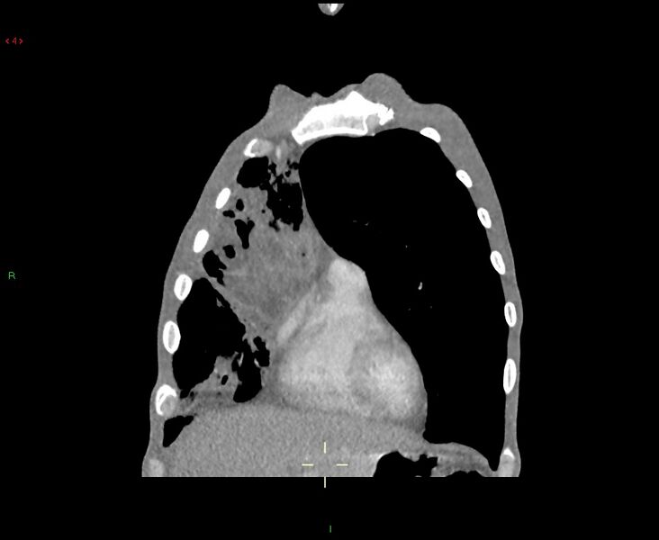 File:Acute right lung abscess (Radiopaedia 34806-36258 Coronal C+ arterial phase 46).jpg