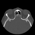Acute sinusitis (Radiopaedia 23161-23215 Axial bone window 56).jpg