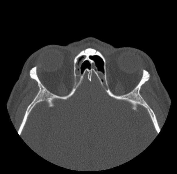 File:Acute sinusitis (Radiopaedia 23161-23215 Axial bone window 56).jpg