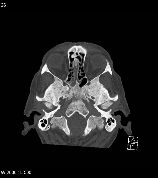 File:Acute subdural hematoma with myelofibrosis (Radiopaedia 52582-58494 Axial bone window 13).jpg