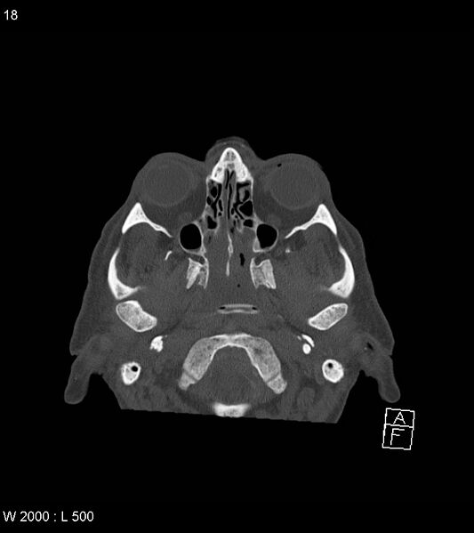 File:Acute subdural hematoma with myelofibrosis (Radiopaedia 52582-58494 Axial bone window 9).jpg