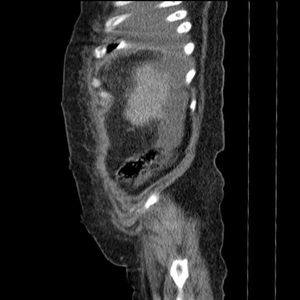 File:Acute tubular necrosis (Radiopaedia 28077-28334 Sagittal non-contrast 14).jpg
