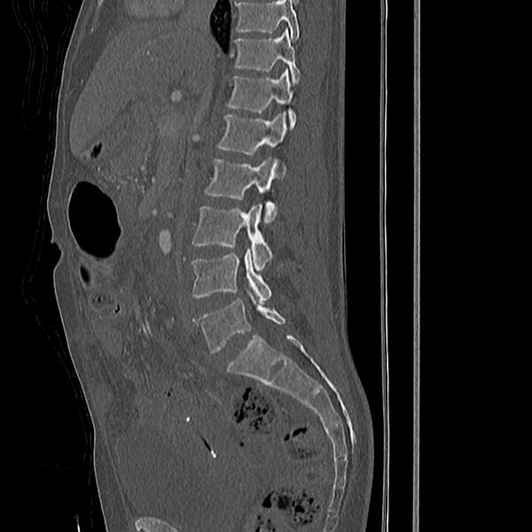 File:Acute vertebral body compression fractures (Radiopaedia 31757-32693 Sagittal bone window 31).jpg