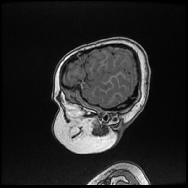 File:Adamantinomatous craniopharyngioma (Radiopaedia 77407-89529 Sagittal T1 C+ 15).jpg