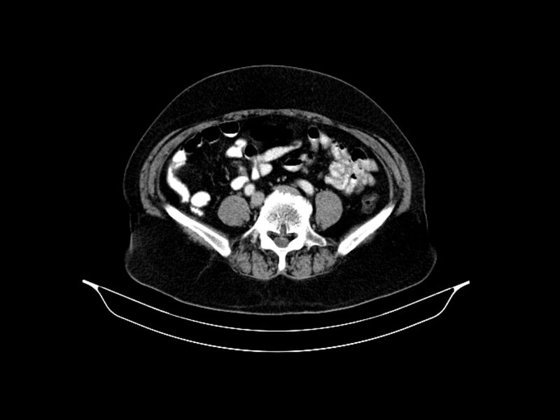 File:Adenocarcinoma of pancreas with hepatic metastasis (Radiopaedia 64332-73122 Axial C+ portal venous phase 70).jpg