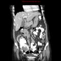 Adenocarcinoma of the colon (Radiopaedia 8191-9039 Coronal liver window 16).jpg