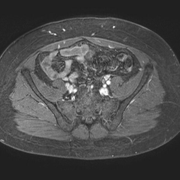File:Adenomyoma of the uterus (Radiopaedia 9871-10439 Axial T1 C+ fat sat 21).jpg