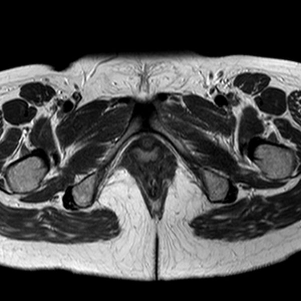 File:Adenomyoma of the uterus (Radiopaedia 9871-10439 Axial T2 1).jpg