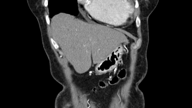 File:Adenomyomatosis of the gallbladder (Radiopaedia 12142-12483 Coronal C+ arterial phase 1).jpg