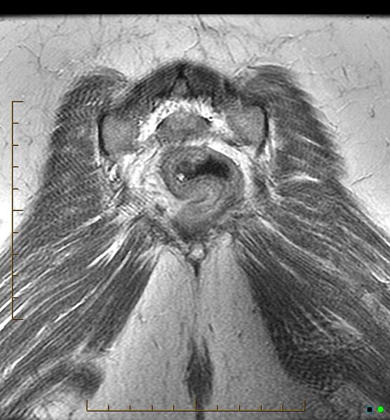 File:Adenomyosis uterus with hematometra (Radiopaedia 45779-50011 Coronal T2 27).jpg