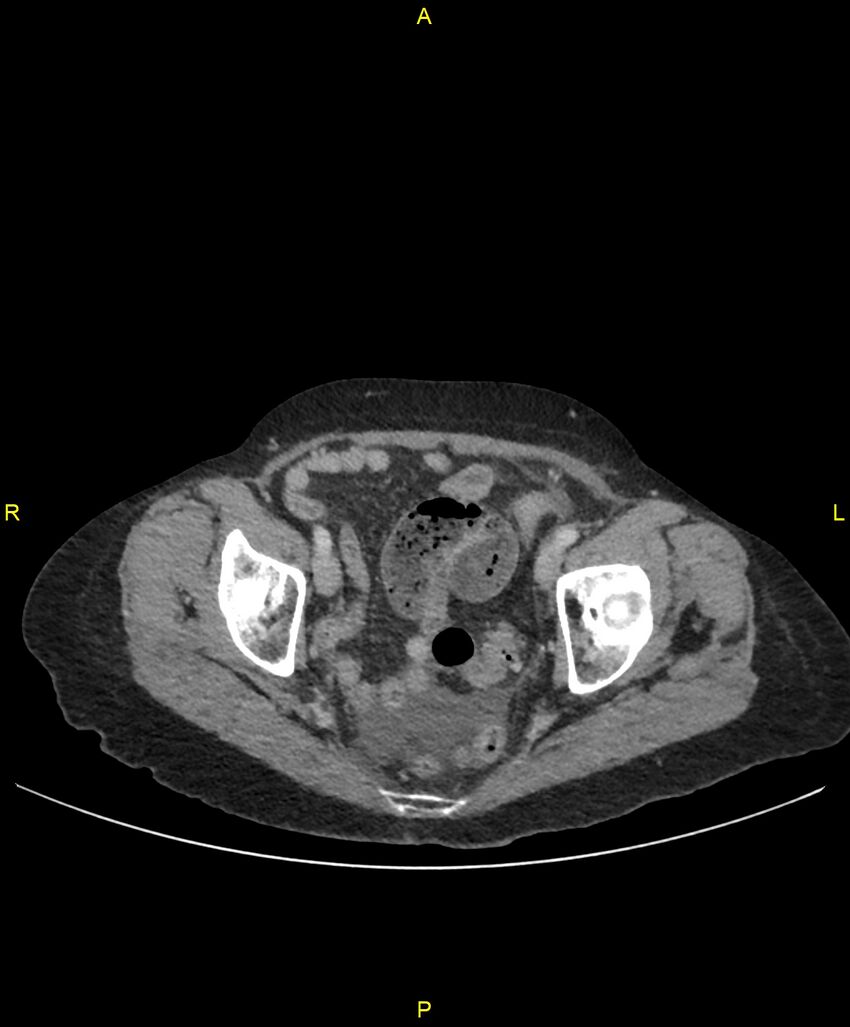 Adhesional small bowel obstruction (Radiopaedia 85402-101024 Axial C+ portal venous phase 252).jpg