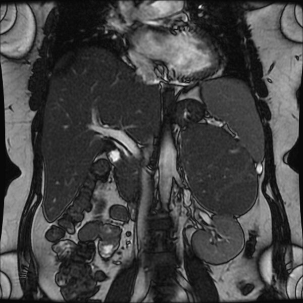 File:Adrenal cortical carcinoma (Radiopaedia 70906-81116 Coronal FIESTA 14).jpg