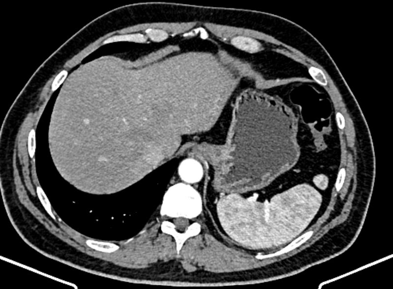 File:Adrenal metastases (Radiopaedia 73082-83791 Axial C+ arterial phase 24).jpg