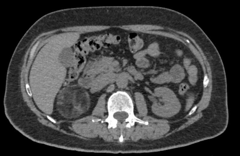 File:Adrenal myelolipoma (Radiopaedia 65240-74253 Axial non-contrast 54).jpg