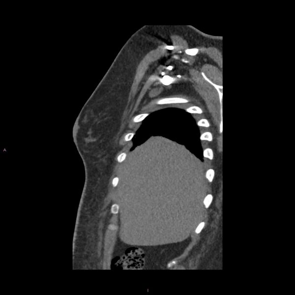 File:Agenesis of the left hepatic lobe (Radiopaedia 77284-89359 Sagittal C+ CTPA 11).jpg