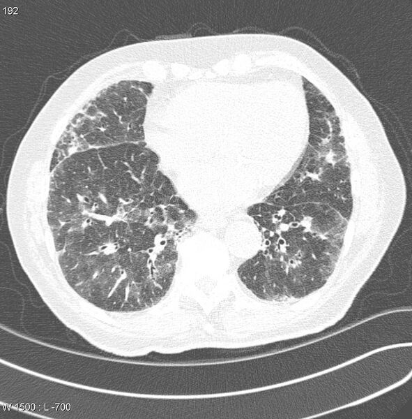 File:Amiodarone lung (Radiopaedia 6539-7851 Axial lung window 19).jpg