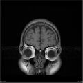 Amnestic syndrome secondary to hypoxic brain injury (Radiopaedia 24743-25004 B 23).jpg