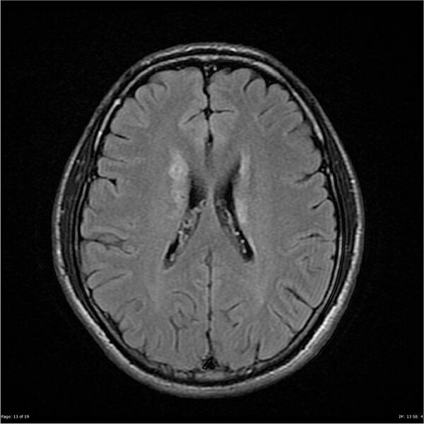 File:Amnestic syndrome secondary to hypoxic brain injury (Radiopaedia 24743-25004 FLAIR 13).jpg