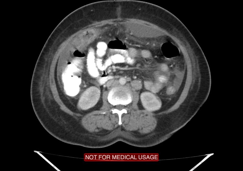 File:Amoebic enterocolitis with liver abscess (Radiopaedia 35100-36609 A 40).jpg