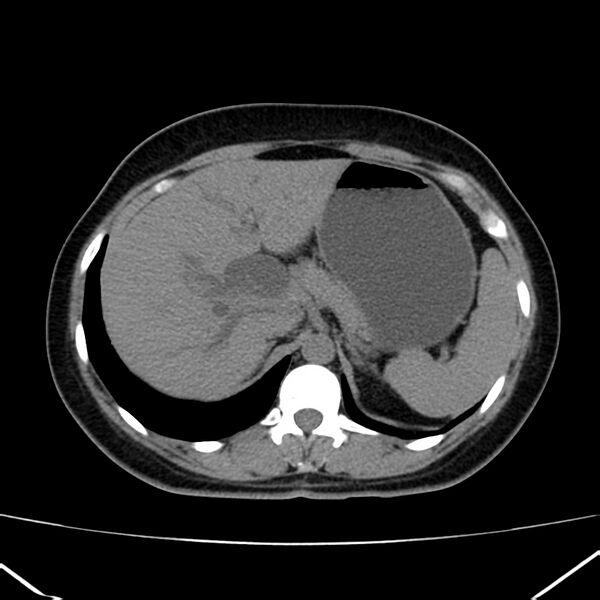 File:Ampullary tumor (Radiopaedia 22787-22816 Axial non-contrast 14).jpg