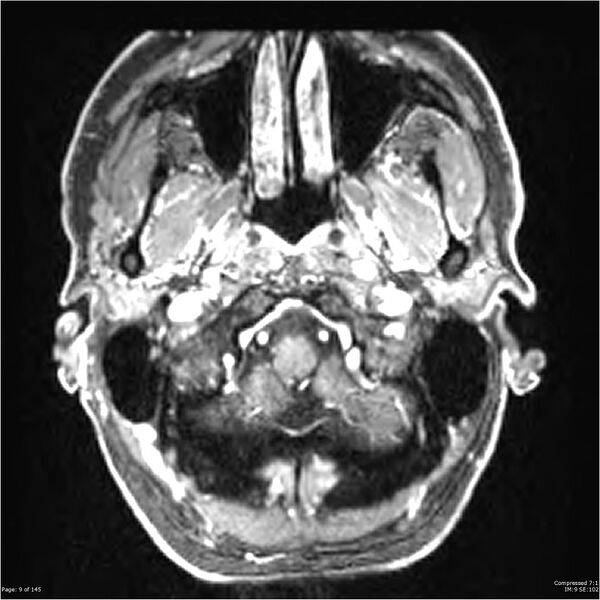 File:Anaplastic meningioma with recurrence (Radiopaedia 34452-35788 Axial T1 C+ 9).jpg