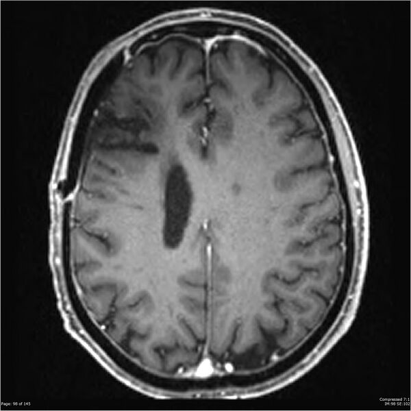 File:Anaplastic meningioma with recurrence (Radiopaedia 34452-35788 Axial T1 C+ 98).jpg
