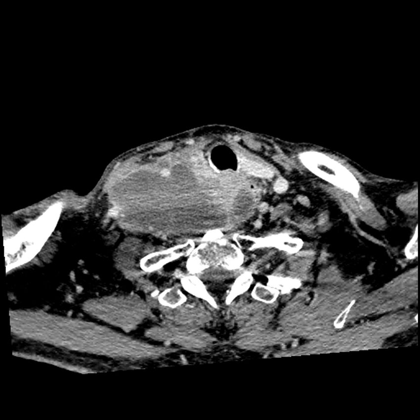 Anaplastic thyroid carcinoma (Radiopaedia 79087-92034 B 39).jpg