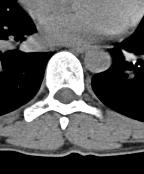 File:Aneurysmal bone cyst T11 (Radiopaedia 29294-29721 Axial non-contrast 14).jpg