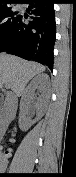 File:Aneurysmal bone cyst T11 (Radiopaedia 29294-29721 E 73).jpg