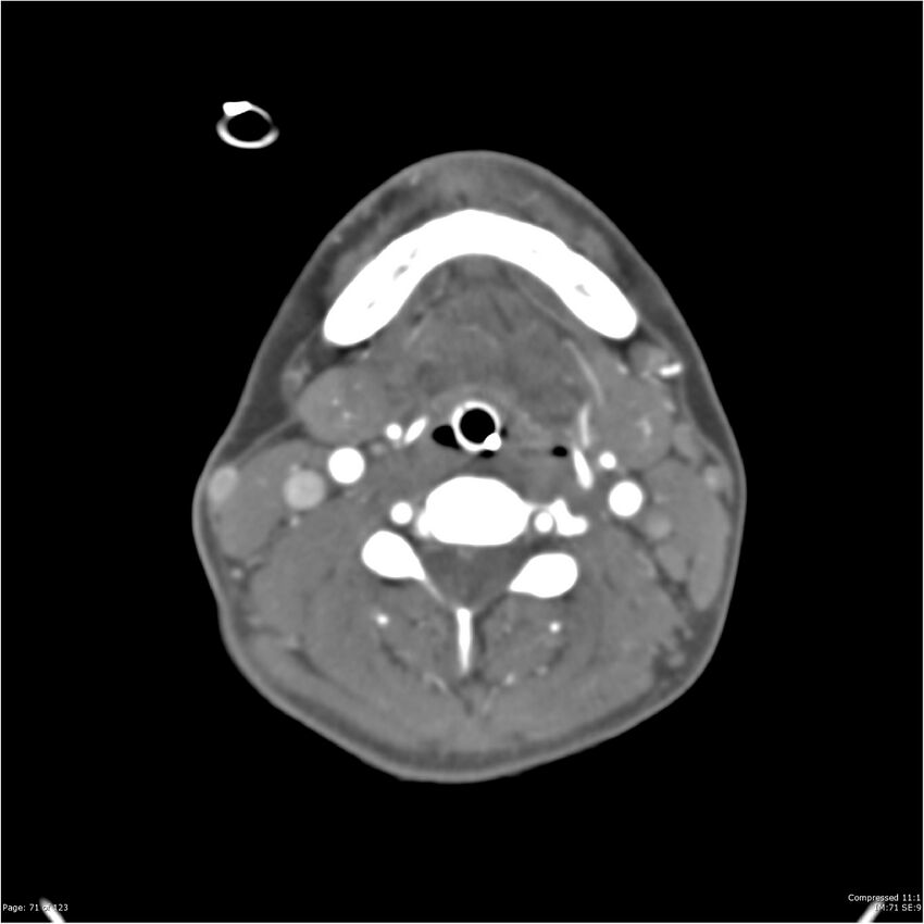 Aneurysmal subarachnoid hemorrhage and Moya Moya disease (Radiopaedia 34306-35593 Axial CT COW 71).jpg