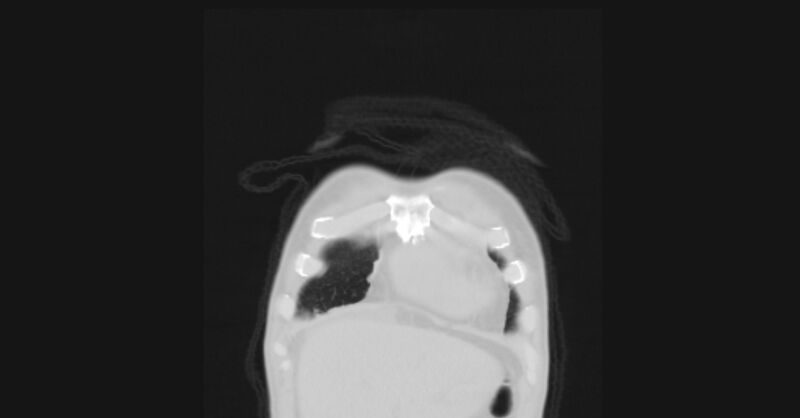File:Angioinvasive aspergellosis (Radiopaedia 66995-76315 Coronal lung window 2).jpg