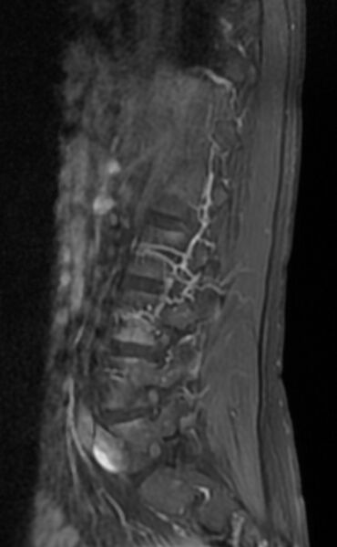 File:Ankylosing spondylitis - Andersson lesion (Radiopaedia 81878-95838 F 10).jpg
