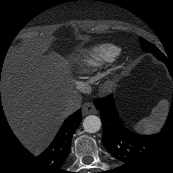 File:Anomalous origin of left circumflex artery from right coronary sinus (Radiopaedia 72563-83117 B 161).jpg