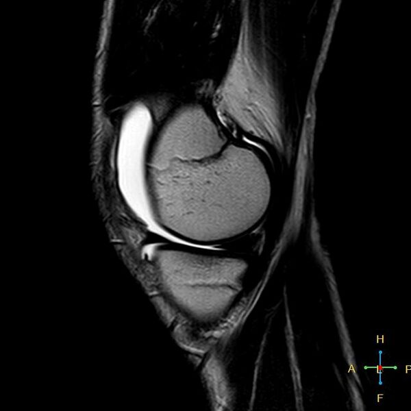 File:Anterior cruciate ligament tear - complete (Radiopaedia 24907-25170 Sagittal T2 15).jpg