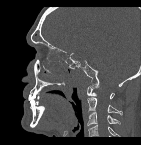 File:Antrochoanal polyp (Radiopaedia 79011-92169 Sagittal bone window 17).jpg