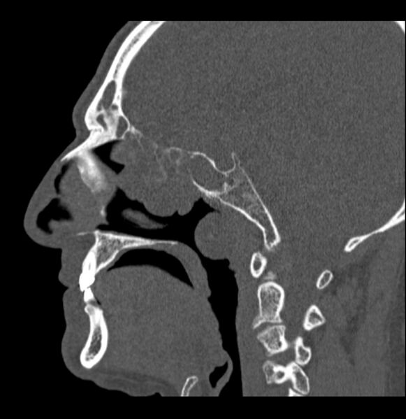 File:Antrochoanal polyp (Radiopaedia 79011-92169 Sagittal bone window 36).jpg