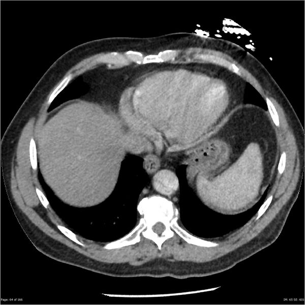 File:Aortic dissection- Stanford A (Radiopaedia 37759-39664 A 55).jpg