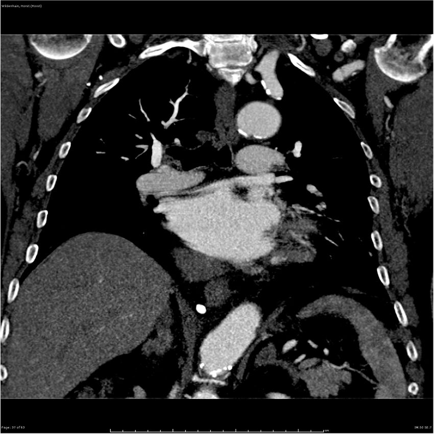 Aortic dissection - Stanford type A (Radiopaedia 26183-26315 A 37).jpg