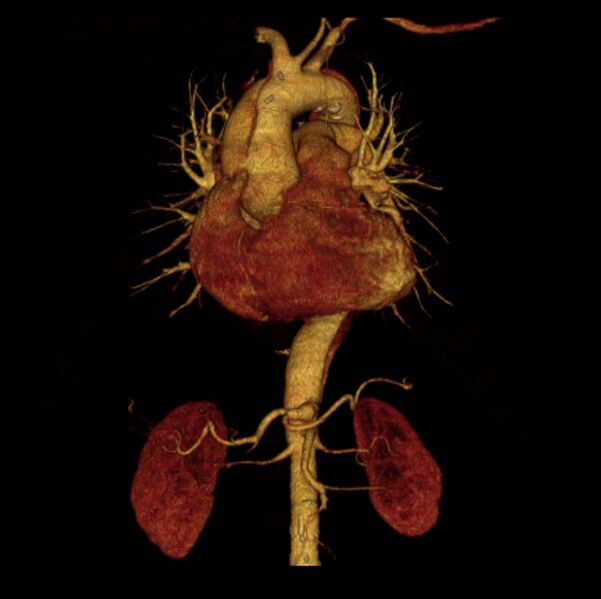 File:Aortic dissection with rupture into pericardium (Radiopaedia 12384-12647 D 1).jpg