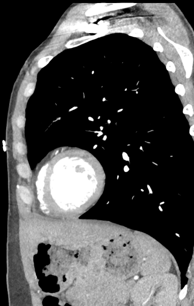 File:Aortic valve non-coronary cusp thrombus (Radiopaedia 55661-62189 C+ arterial phase 10).png