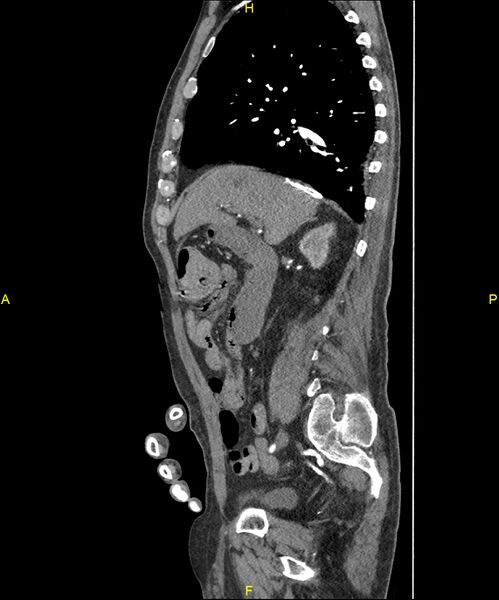 File:Aortoenteric fistula (Radiopaedia 84308-99603 C 127).jpg