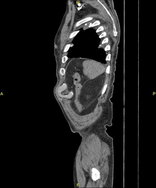 File:Aortoenteric fistula (Radiopaedia 84308-99603 C 306).jpg