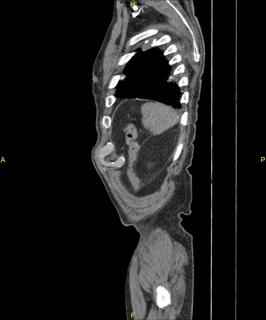 Aortoenteric fistula (Radiopaedia 84308-99603 C 306).jpg
