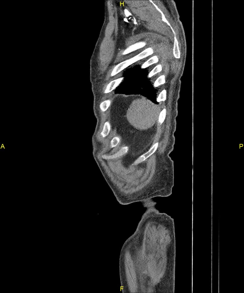 Aortoenteric fistula (Radiopaedia 84308-99603 C 316).jpg