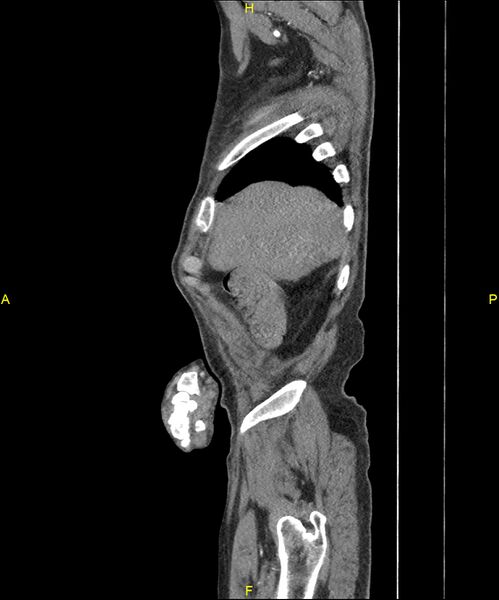 File:Aortoenteric fistula (Radiopaedia 84308-99603 C 41).jpg